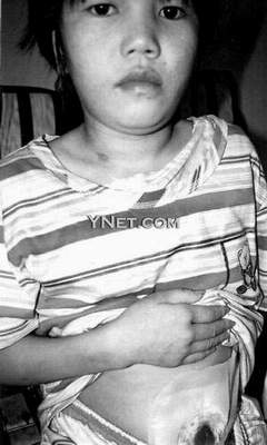 10岁<em>幼女</em>遭强奸肠子挂体外 拼死逃离鬼门关(<em>图</em>
