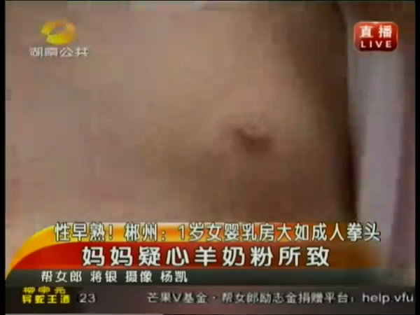 [视频]性早熟 郴州1岁女婴乳房大如成人拳头 妈
