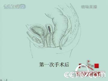 [<em>视频</em>]花季<em>少女</em>无肛门20年
