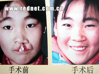 ( 唇腭裂 (俗称 兔唇 )患者实施免费手术前后对比照