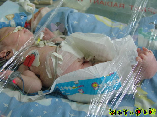 手术台上造瘘术后的宝宝