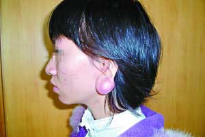 女孩打耳洞致耳垂肿胀如鸡蛋(图)