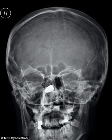 子弹卡在鼻骨处的x光片