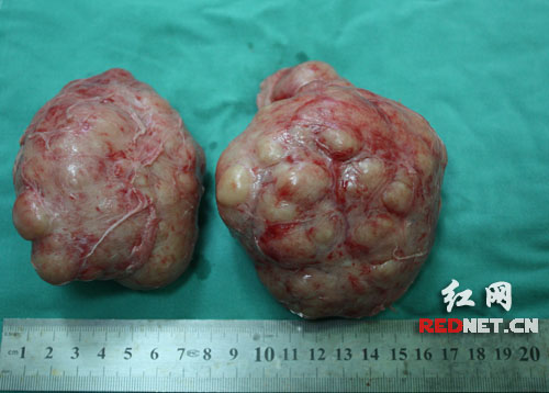 雅三医院泌尿外科摘除重达450克增生前列腺(图