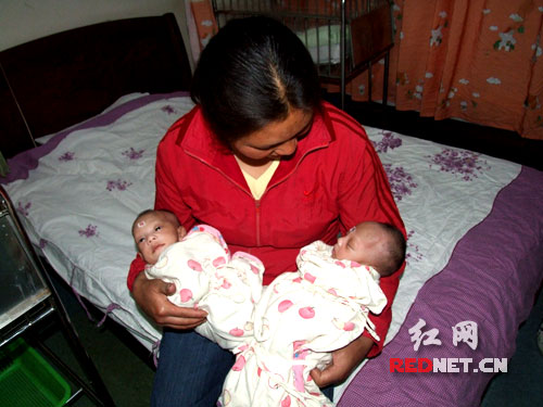 湖南连体婴儿进入全面康复期 呼吁市民伸出援