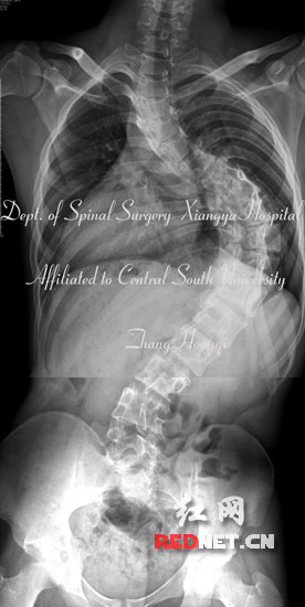 男孩脊柱扭曲成S型 湘雅脊柱外科助其新生