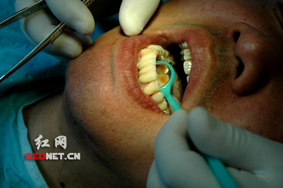 下颌骨切了会毁容? 全球首例下颌重生患者表示