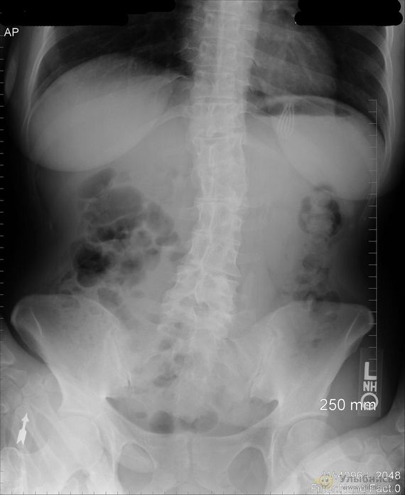 难得一见的X光<em>照片</em>:<em>人体</em>内匪夷所思的异物 - 日