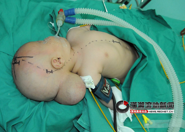 一个婴儿两个头 <em>孕妇</em>产前检查不容忽视[图]