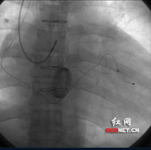 不用开胸手术 湘雅医院为心脏病患者装上永久起搏器