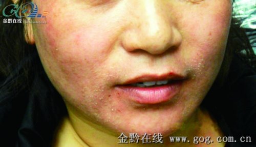 女子擦玉兰油致满脸红肿留<em>黑斑</em>索赔遭商家威胁