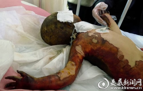 烤鞋器引发火灾2岁女孩被烧伤 巨额手术费盼好