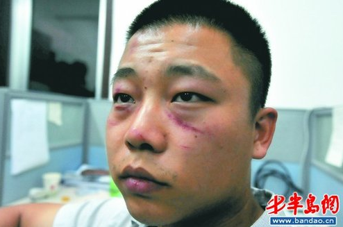 蓝色快报一名员工的脸被抓伤