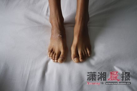 男孩手脚都是六指 他给自己取名六六(图)