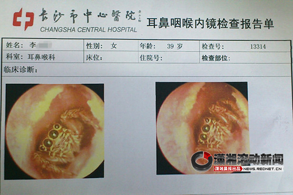 耳朵变盘丝洞蜘蛛住3天 生理盐水逼出活蜘蛛