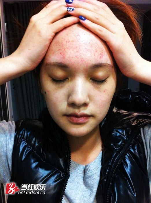 杨丞琳红磡演唱会完美落幕 神经失调引发满面