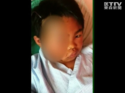 儿童遭狗咬脸缝百针 狗主人弟弟装瞎：狗没出门