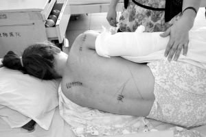 　小吴背部的刀伤 南国都市报记者 贺立樊 摄