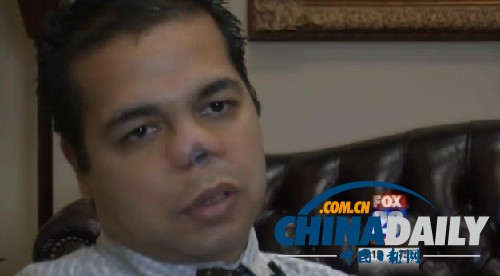 纽约帅气离异男22次整形手术后鼻子感染被割掉