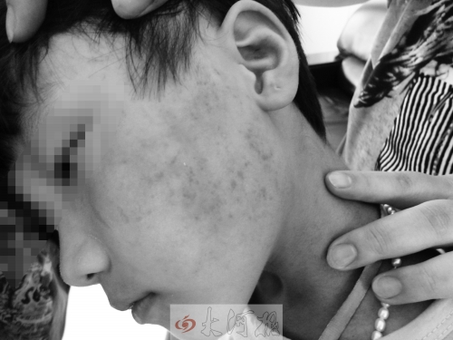 小燕（左）和小雅的伤都还清晰可见