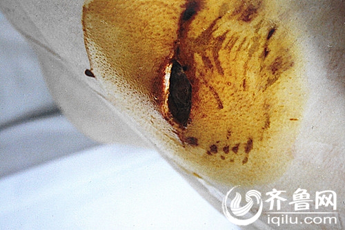 被狗咬的伤口深可及骨
