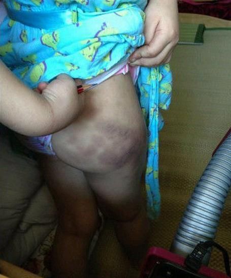 小豆（化名）伤痕累累