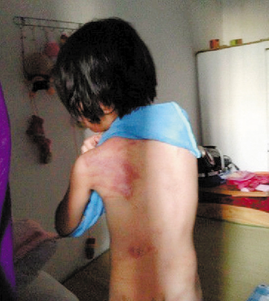 豆子掀开衣服,满身是伤(微博图)