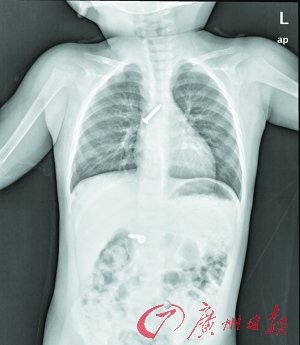 2岁半留守女童误吞两枚钢钉险些丧命(图)