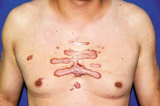 疤痕像“八爪鱼” 夏杨 摄