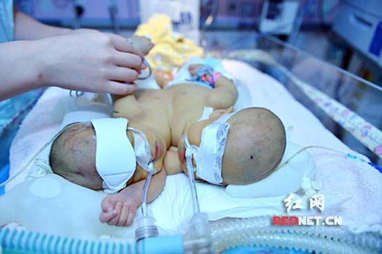 株洲联体姐妹在湖南省儿童医院新生儿一科重症监护室接受24小时特殊护理。李奇摄