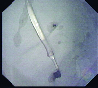 这支“调皮”的牙刷让姜女士吓得不轻。（医院供图）