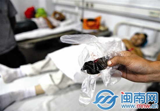 切割机碎片从工人腹中取出