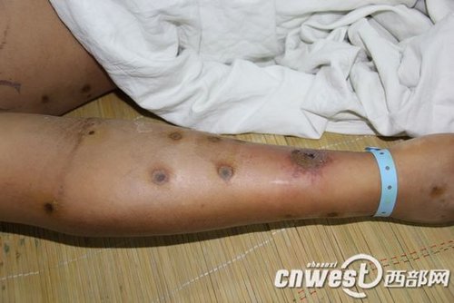 被胡蜂蜇伤的喻师傅全身留下了八十多处伤口，头部和手臂尤其严重。