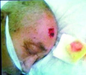 老人头上的伤口。