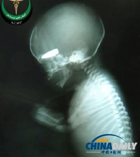 1张X光片，清楚显示1名即将出生的宝宝脑部有颗子弹