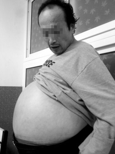 男子肚子大像临盆孕妇 回头率百分百成负担(图)