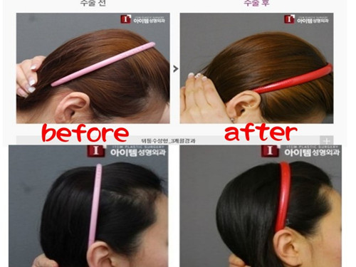 韩国后脑勺整形效果惊人存风险医生吁谨慎（图）