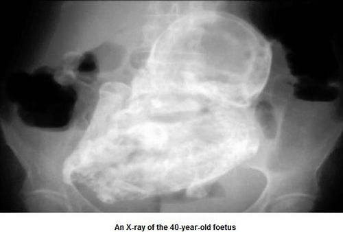 82岁老妇腹腔“石胎”形成40年未察觉（图）