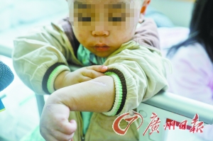 小贝全身多处伤痕，他轻轻地告诉记者说是爸爸打的。