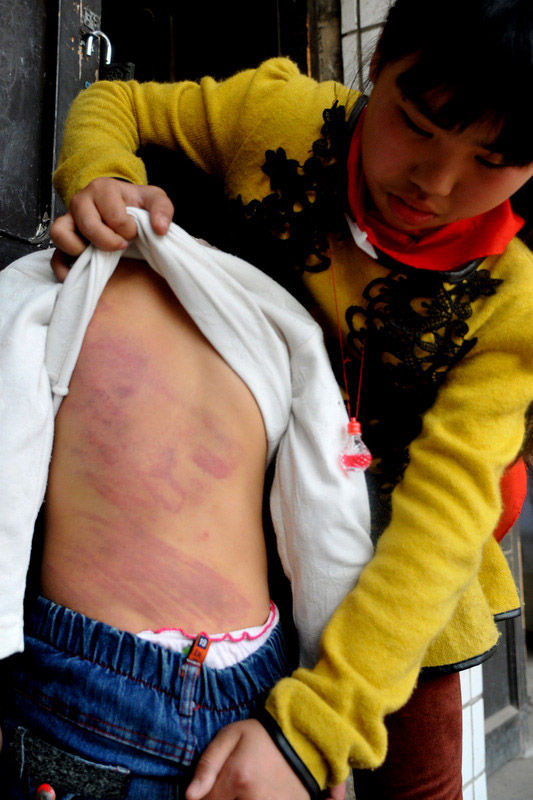 小莉后背满是伤痕。徐晓春摄
