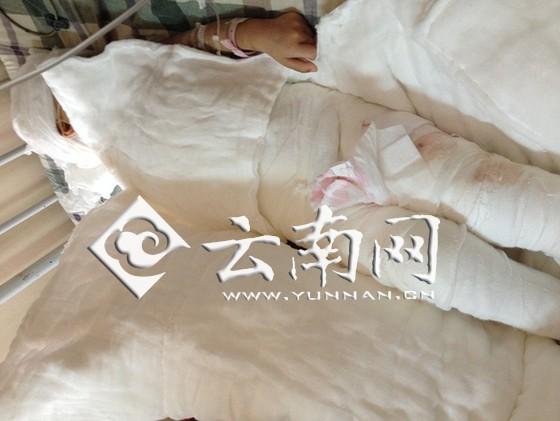 3岁女孩跌入大滚锅被烫伤 母亲放弃治疗女儿(图)
