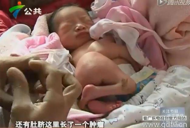 惠州新生儿长4手4脚 疑生母孕时打针吃药(图)