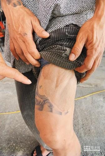 台湾男子烧伤脸 为救命将大腿刺青移植脸上(图)