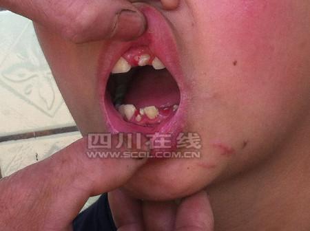 14岁男孩被同学持火药枪打伤体内滞留16颗子弹