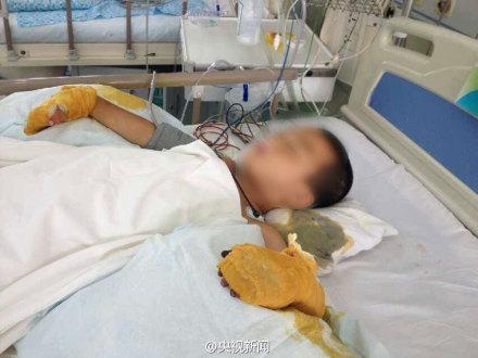 河北6岁男孩遭继母捆绑吊打将截肢