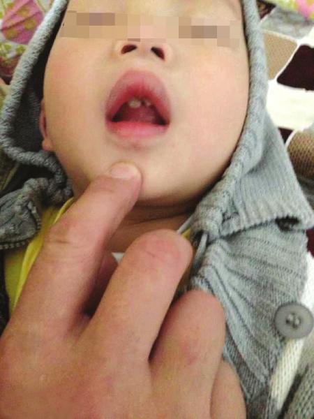 两岁男童幼儿园内磕断门牙 老师归罪“小铃铛”