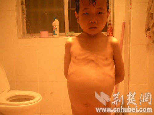 疾病使他的肚子变得鼓鼓的