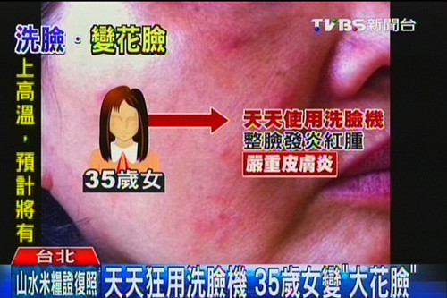 天天用洗脸机35岁女子变“红花脸”(图)