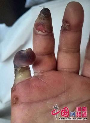 2岁男童公园内摸配电箱遭电击 两根手指被截肢