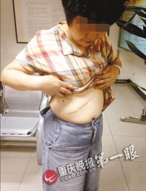 女子在不同医院做两次手术 肚里留下手术针(图)